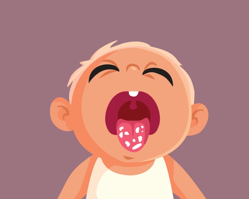 grzybica jamy ustnej kidsclinic