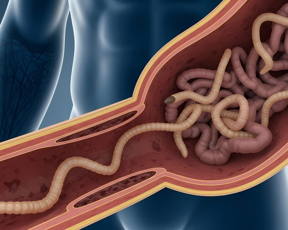Medical illustration showing worms inside a human vein, depicting parasitic infection.