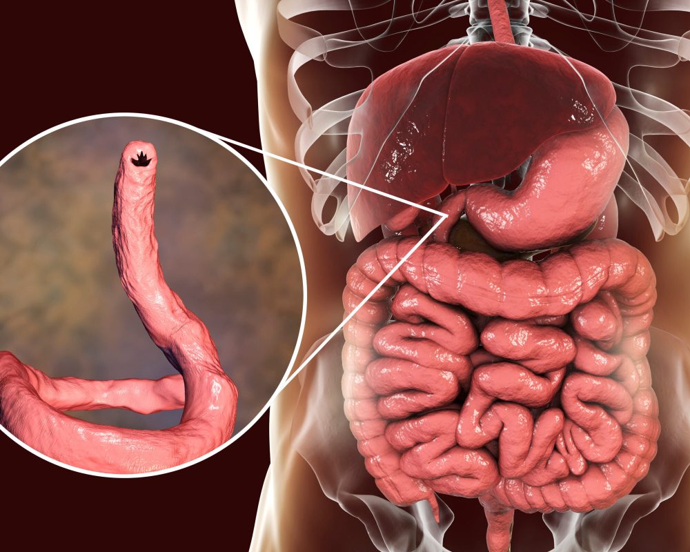 Ancylostomiasis. Human intestine and close-up view of a parasitic hookworm Ancylosoma duodenale, 3D illustration. It infects humans, dogs and cats, its head has several tooth-like structures